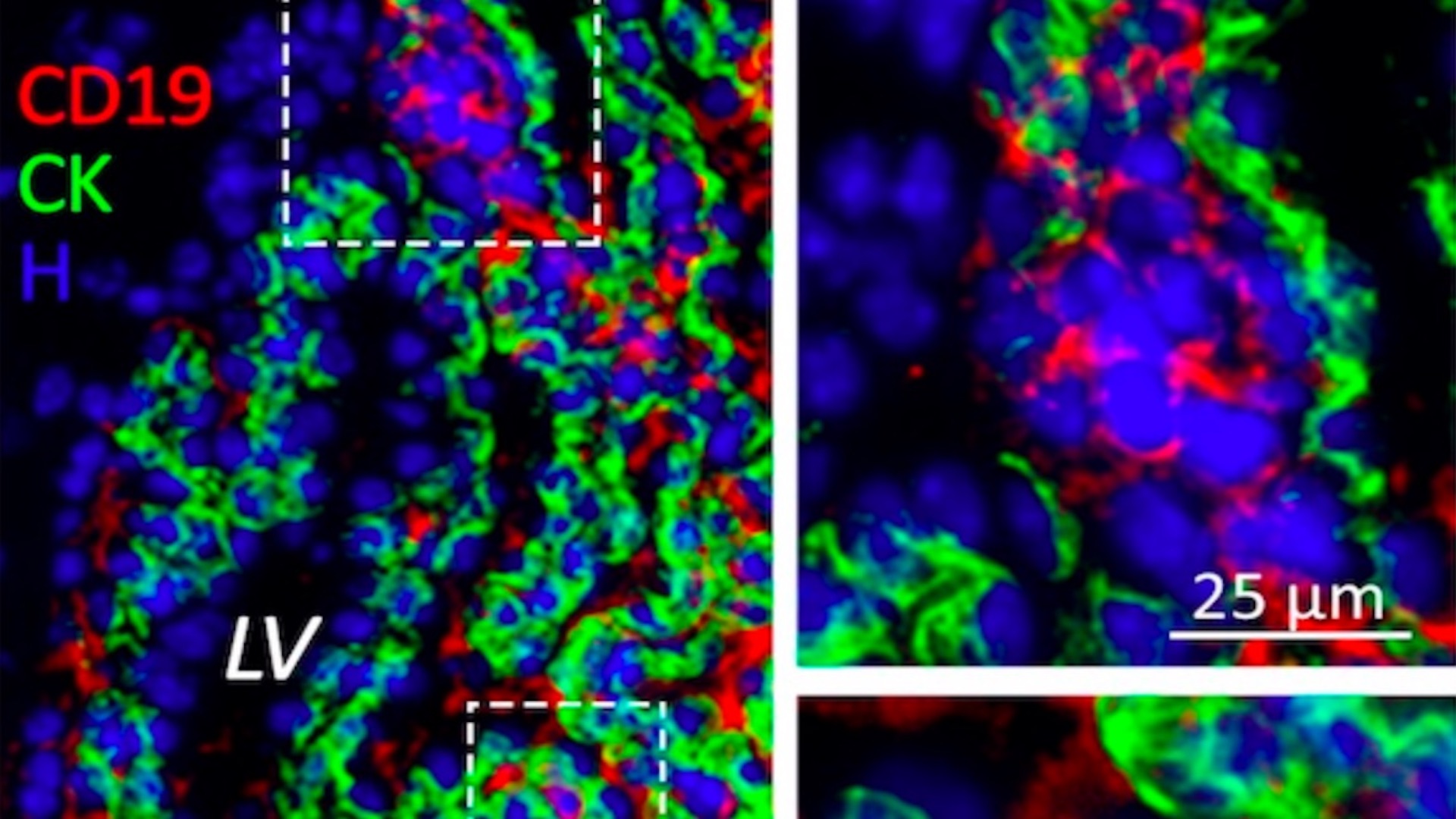 Universidad Autónoma de Chihuahua participa en hallazgo de área cerebral donde tumores se ocultan de quimioterapia Universidad Autónoma de Chihuahua participa en hallazgo de área cerebral donde tumores se ocultan de quimioterapia