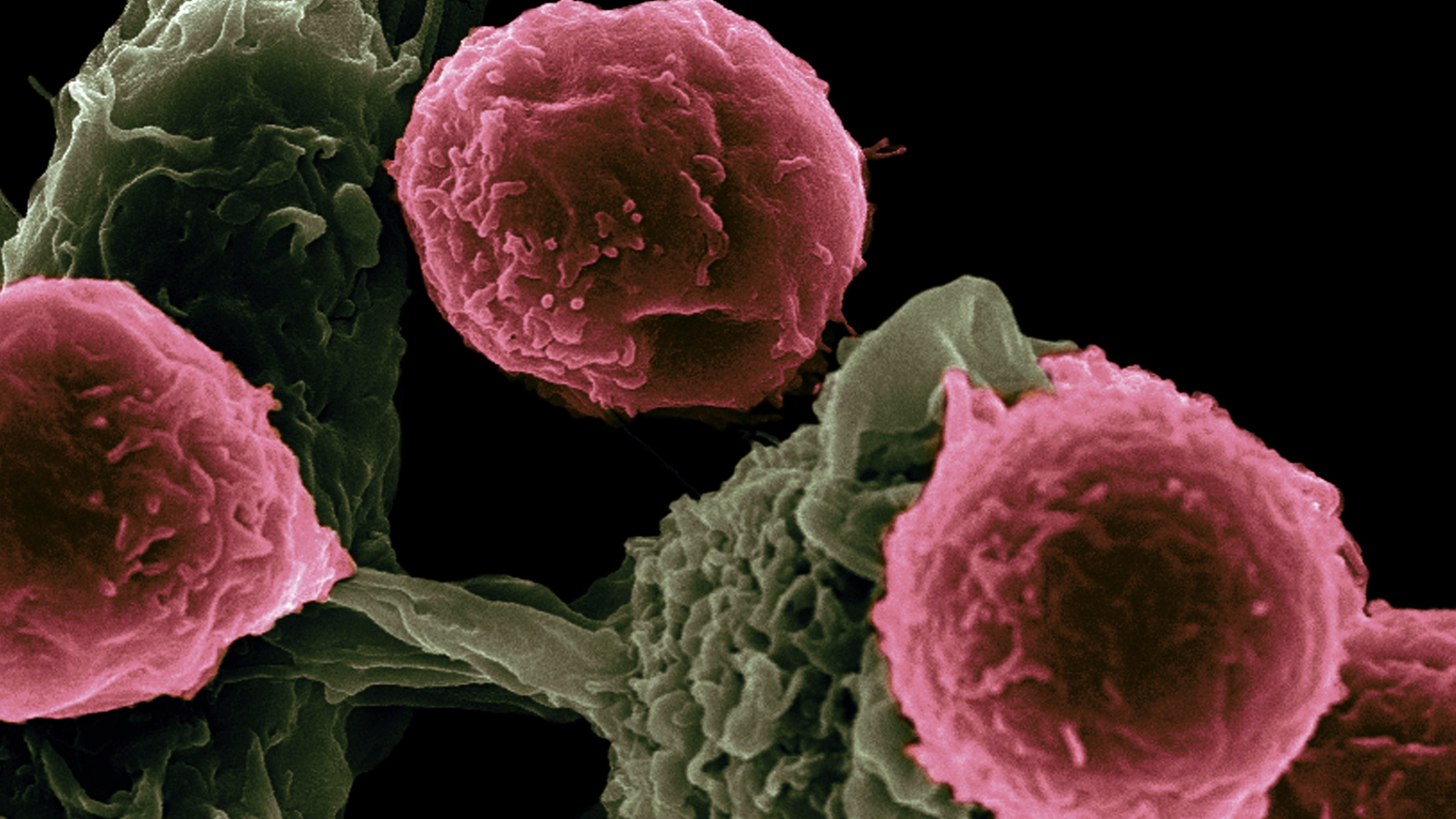 Cáncer de próstata en etapa avanzada genera gastos de 120 mil pesos mensuales en México