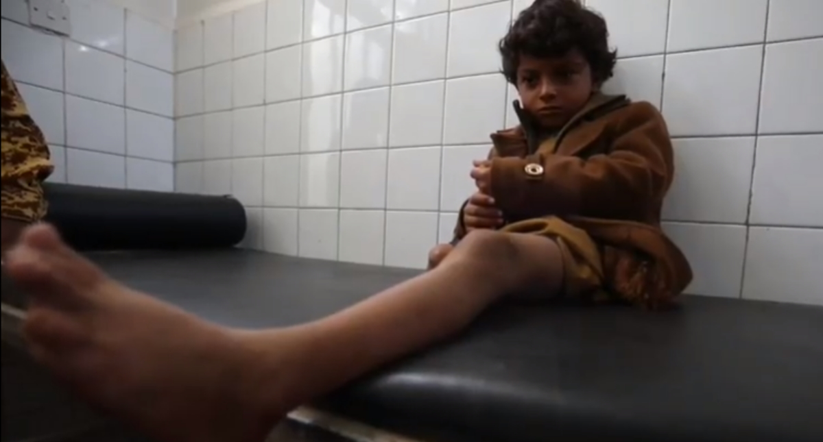 Huérfano y mutilado con 8 años, una de las vidas rotas por la guerra en Yemen
