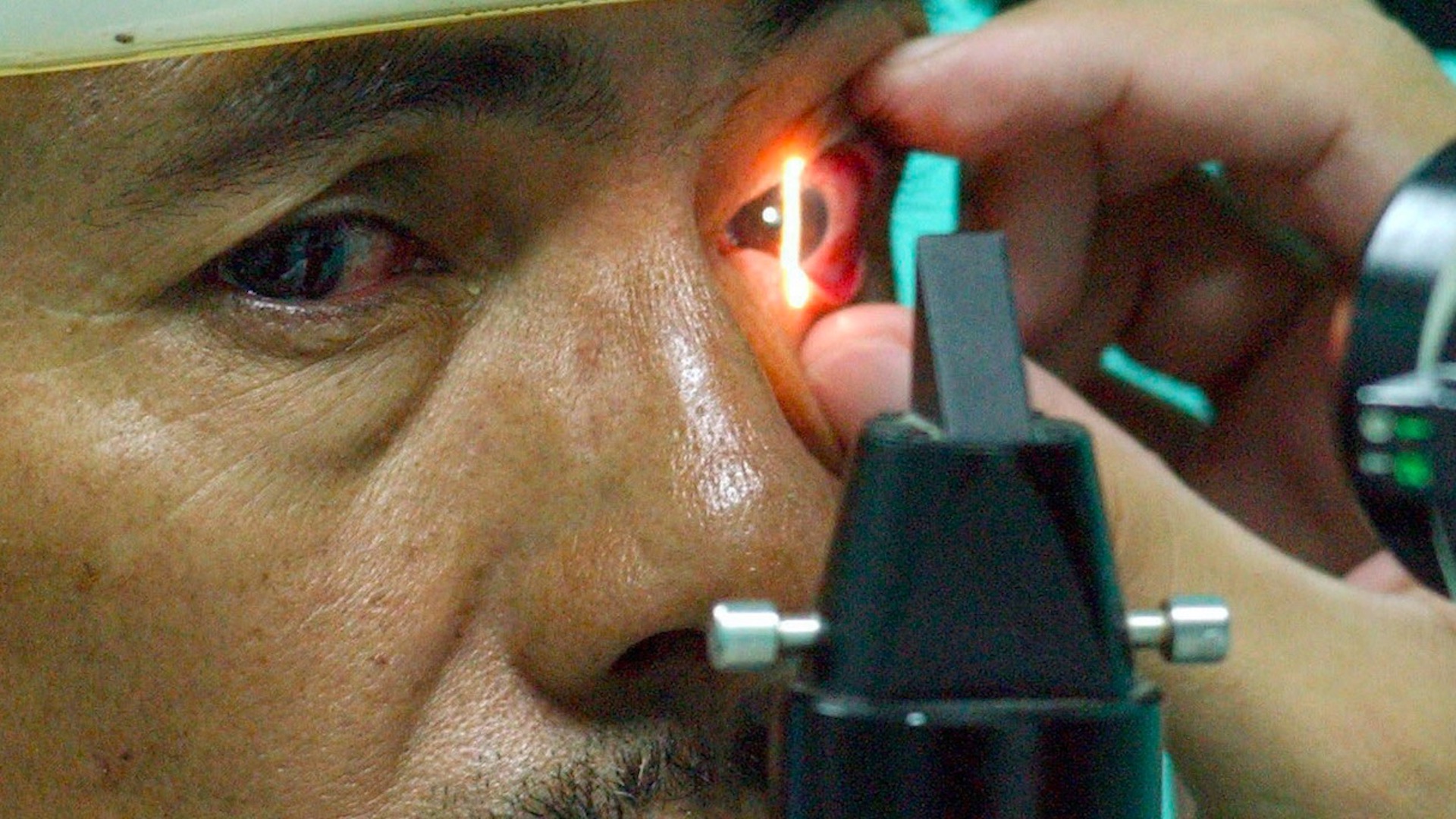 Glaucoma es la primera causa de ceguera en México