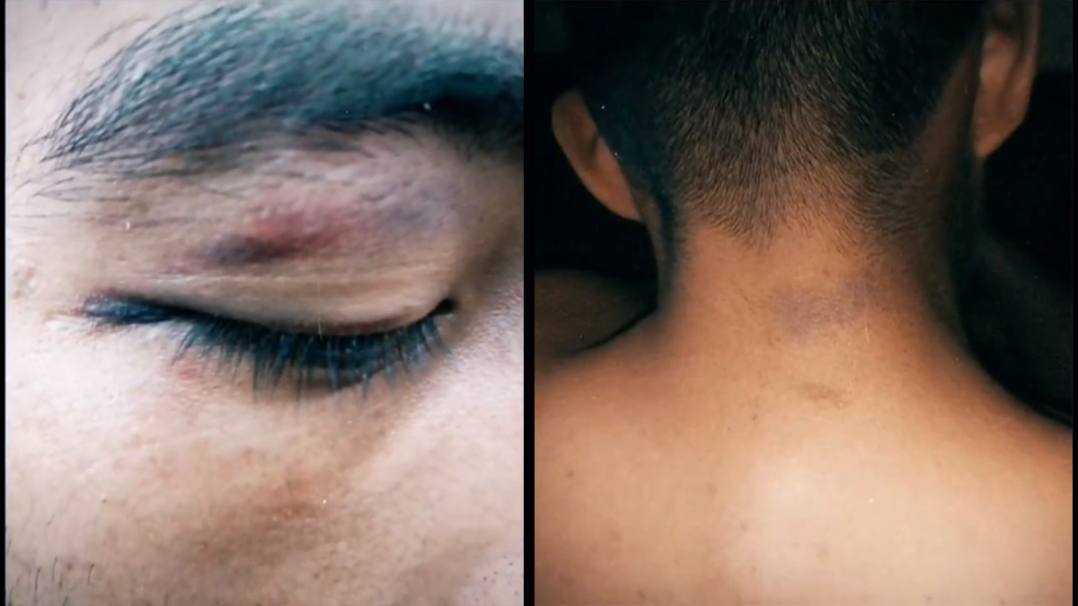 #Video Policías asaltan y golpean a trailero sobre la México-Querétaro - lesiones-de-trailero-causadas-por-policias