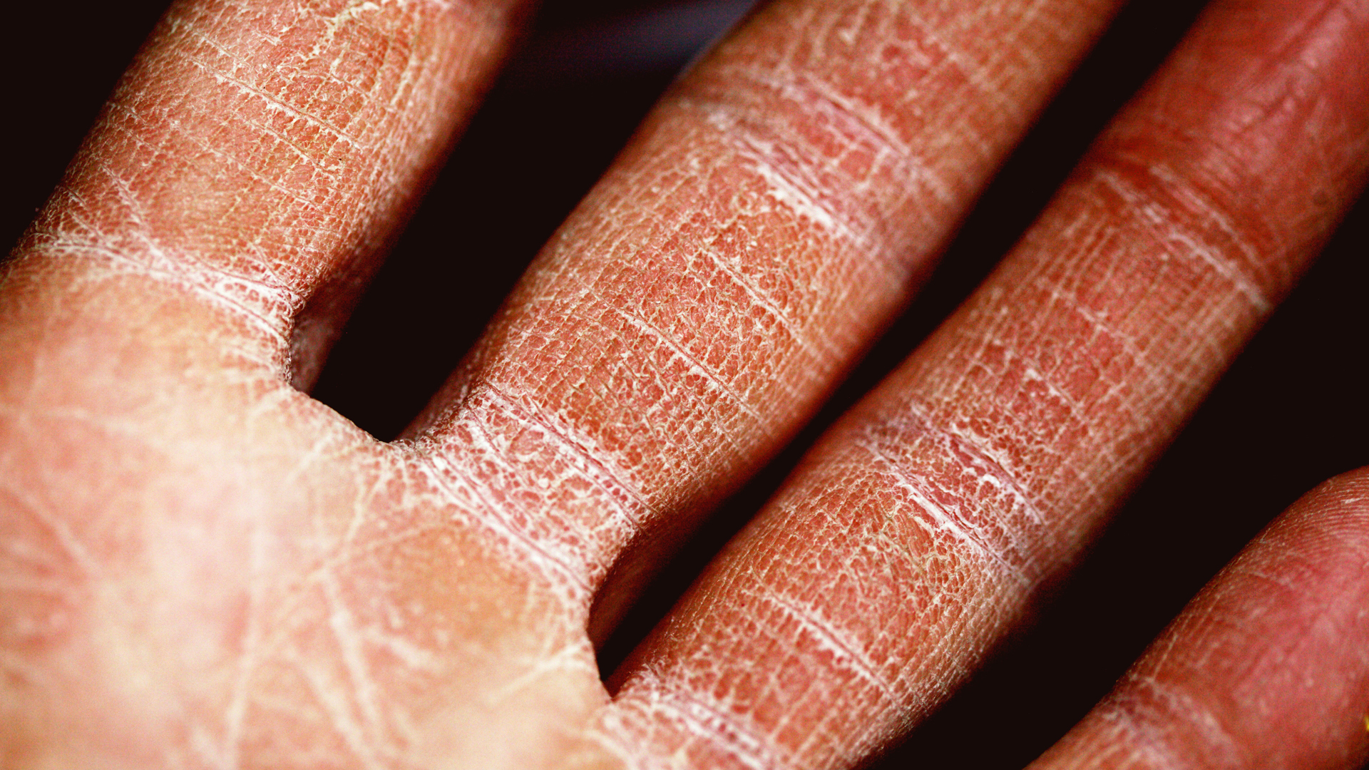 Un 20 por ciento de enfermos de COVID-19 padecen alteraciones en la piel