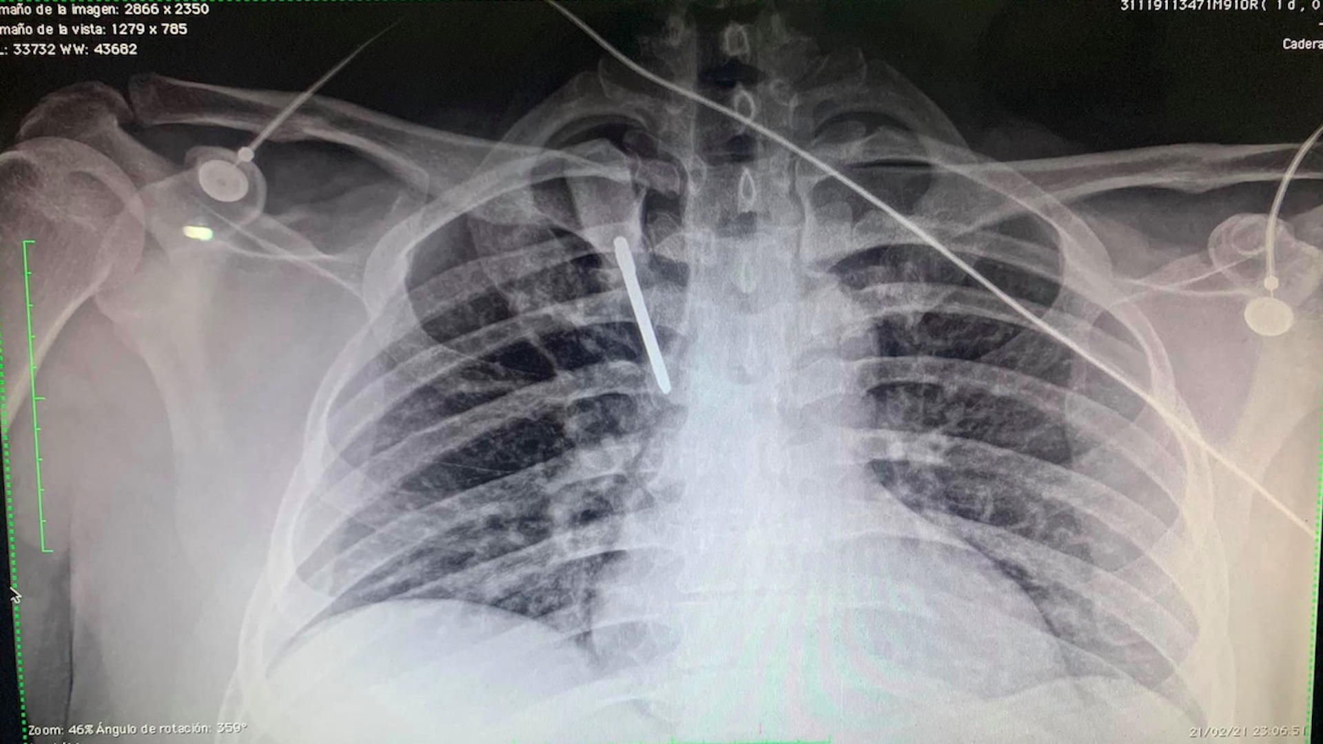 Clavan desarmador a médico residente en Monterrey durante asalto en inmediaciones de hospital