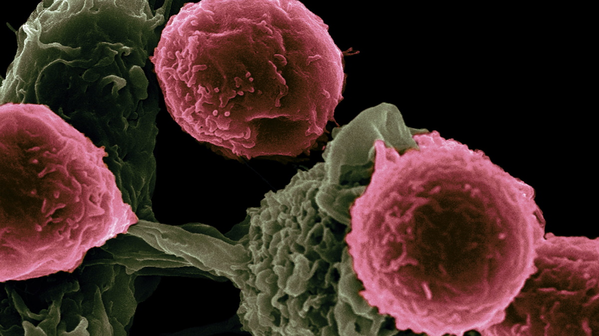 Cáncer de ovario, más letal que el de mama o el cervicouterino Cáncer de ovario, más letal que el de mama o el cervicouterino