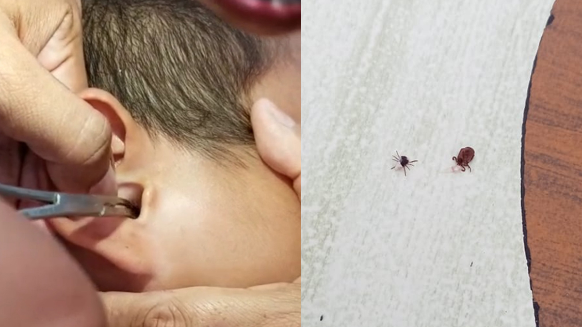 Extraen garrapatas del oído de niño en Yucatán; autoridades piden tomar ‘medidas severas’ de higiene