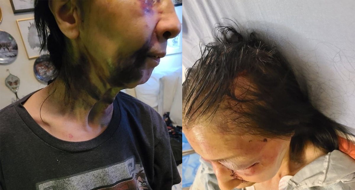 Golpean en Los Ángeles a adulta mayor mexicana; la confundieron con asiática - lesiones-de-becky