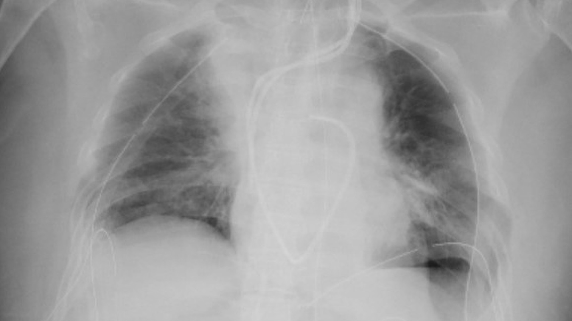 Realizan en Japón el primer trasplante de pulmón a partir de donantes vivos Realizan en Japón el primer trasplante de pulmón a partir de donantes vivos