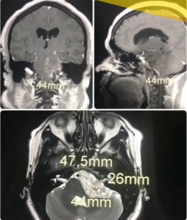 Canelo Álvarez se une a campaña para salvar vida a enfermera con tumor cerebral - tumor-cerebral-de-linda-acuna