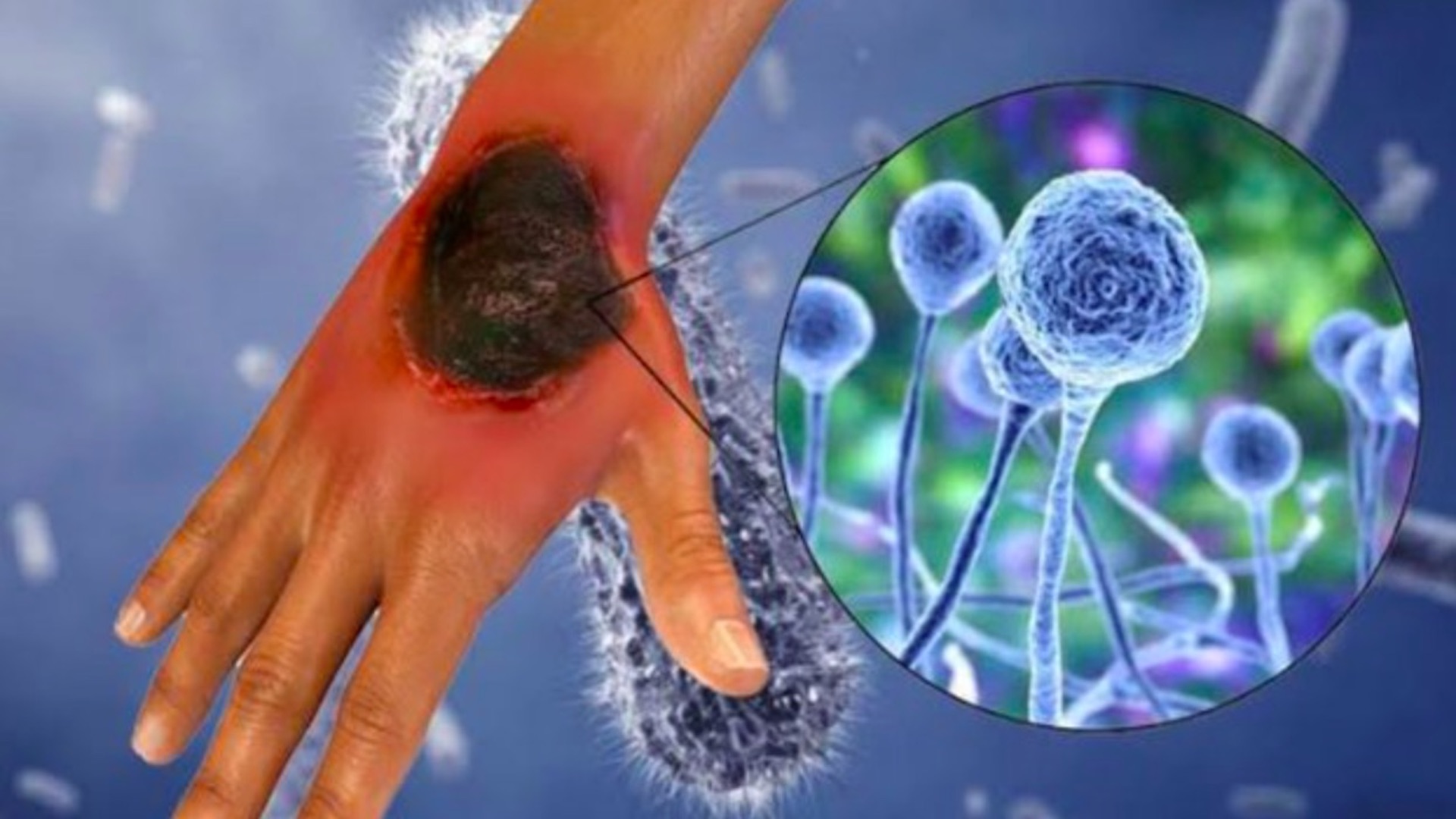 Hongo negro no es de nueva adquisición en México, advierte UNAM Hongo negro no es de nueva adquisición en México, advierte UNAM