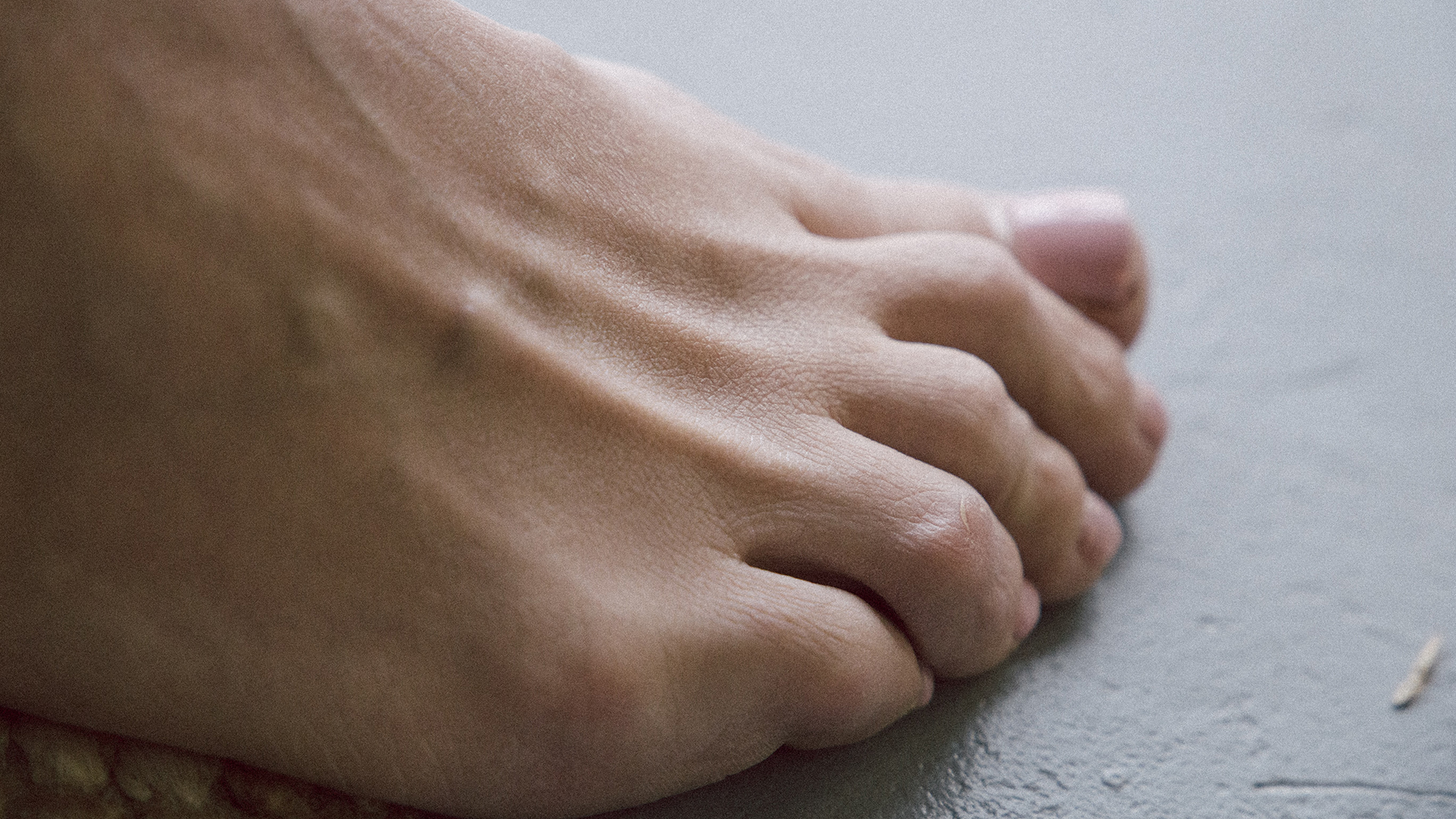 Lesiones en manos y pies podrían ser efecto de la respuesta inmune al COVID-19