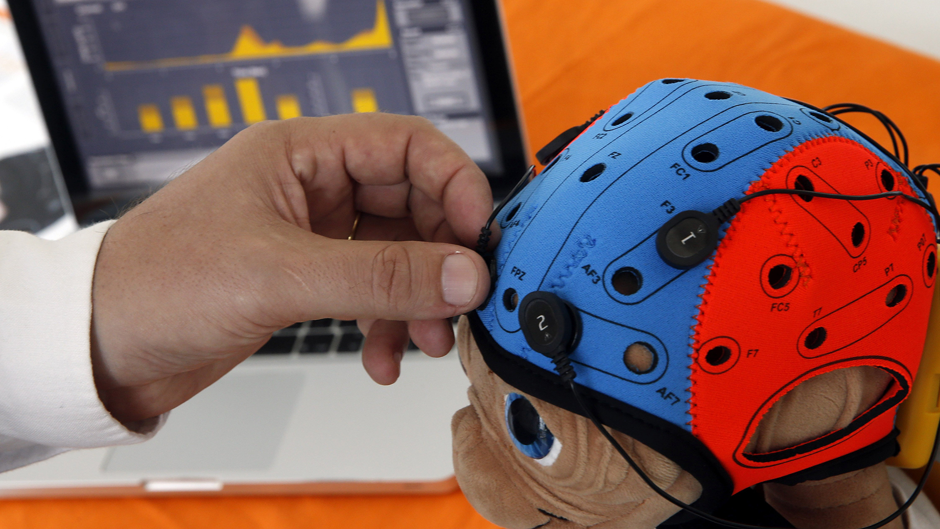 Especialistas llaman a mejorar diagnóstico de parálisis cerebral en México