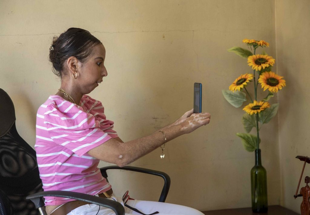 La joven a quien le dieron dos años de vida y vive para contarlo - joven-esclerodermia-sistemica-1024x710