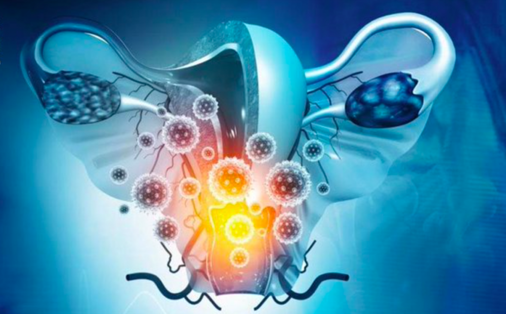 Campaña busca reducir brechas en cáncer cervicouterino, prevenible en 99.7 % en México - vph-cancer-1024x635