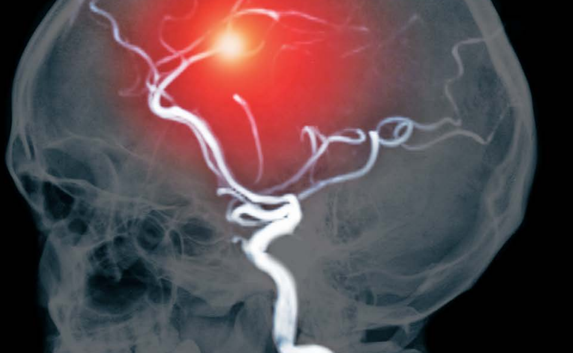 Gaceta UNAM: ¿Qué pasa en el cerebro después de un infarto? Gaceta UNAM: ¿Qué pasa en el cerebro después de un infarto?