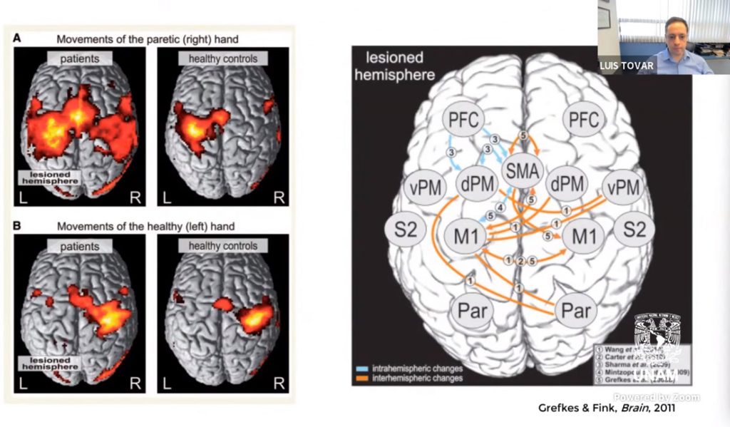 Estudian cómo un infarto cerebral modifica las conexiones neuronales - cerebro-infarto-cerebral-estudio-1024x599