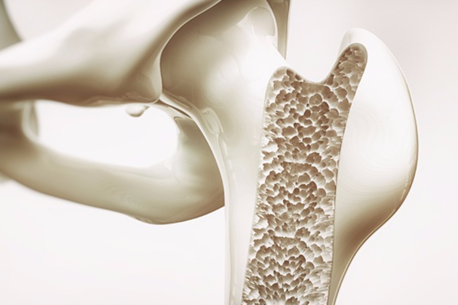 Expertos prevén que osteoporosis se duplique en América Latina para 2050