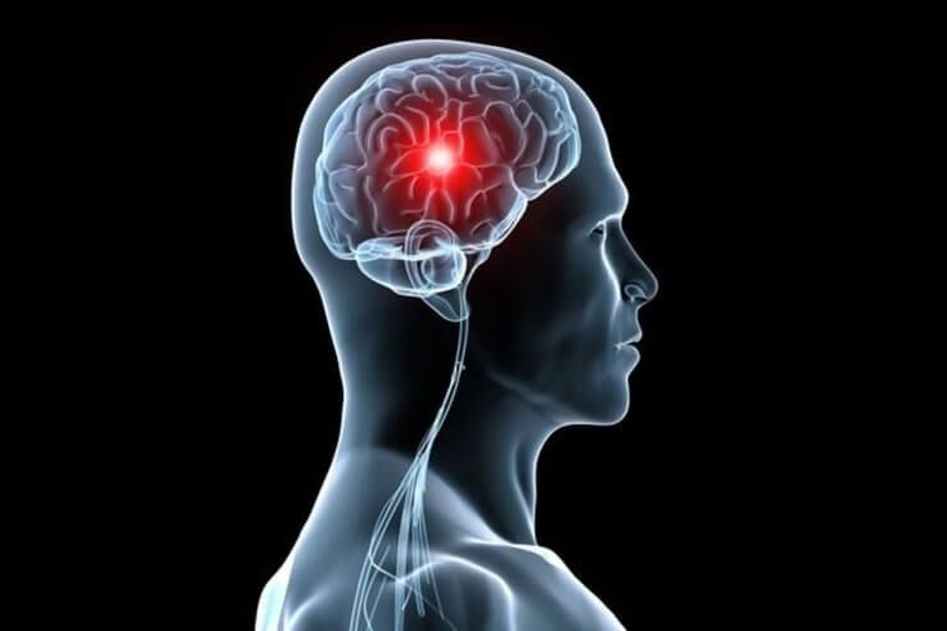 Hallan 89 genes implicados en el riesgo de sufrir un ictus