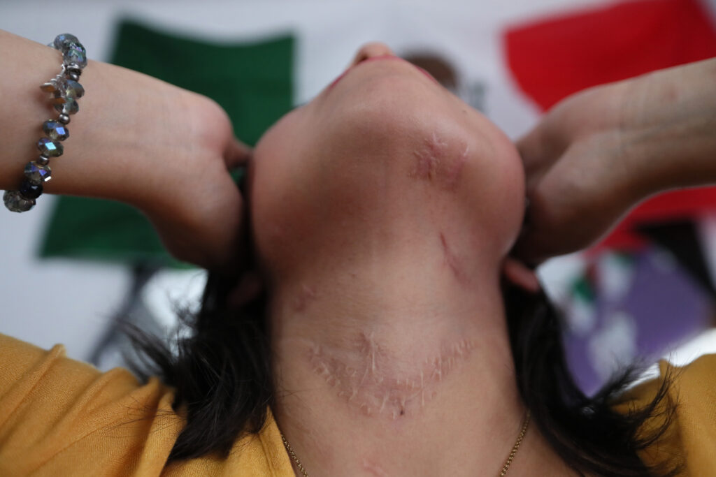 "Vivir sin miedo", el reto de una víctima de intento de feminicidio en México - vivir-sin-miedo-el-reto-de-una-victima-de-intento-de-feminicidio-en-mexico-2-1024x683