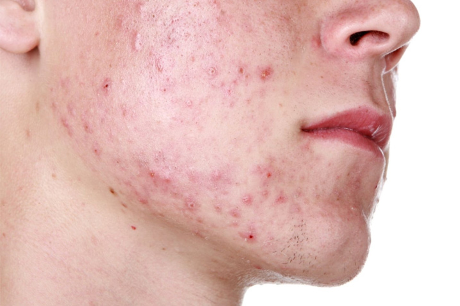 Especialista alerta que 90 % de adolescentes y 40 % de adultos en México padecen acné Especialista alerta que 90 % de adolescentes y 40 % de adultos en México padecen acné