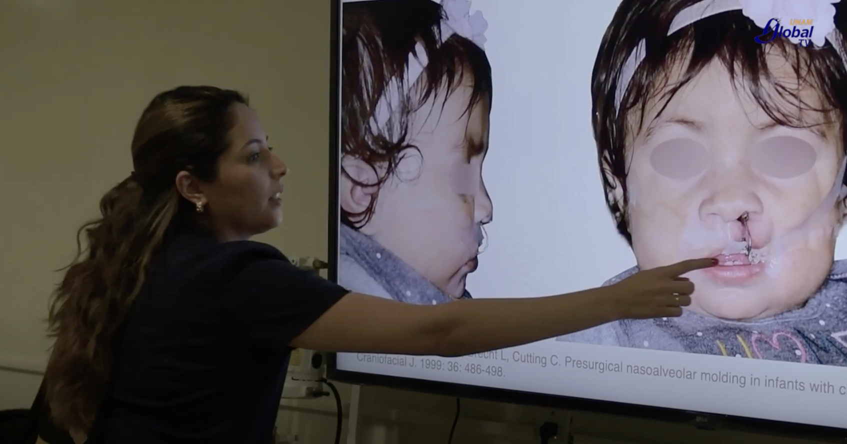 UNAM rehabilita de manera gratuita a niños con labio y paladar hendido