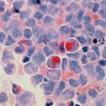 El cáncer es la principal causa de muerte entre los hispanos de EE.UU., según un estudio