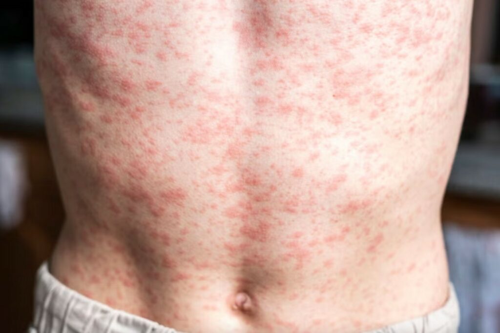 OPS afirma que persiste el brote de sarampión en México