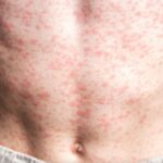 OPS afirma que persiste el brote de sarampión en México