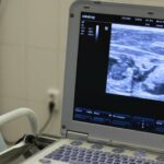 Bebé en gestación es operado de un tumor en el pulmón en hospital de Lima