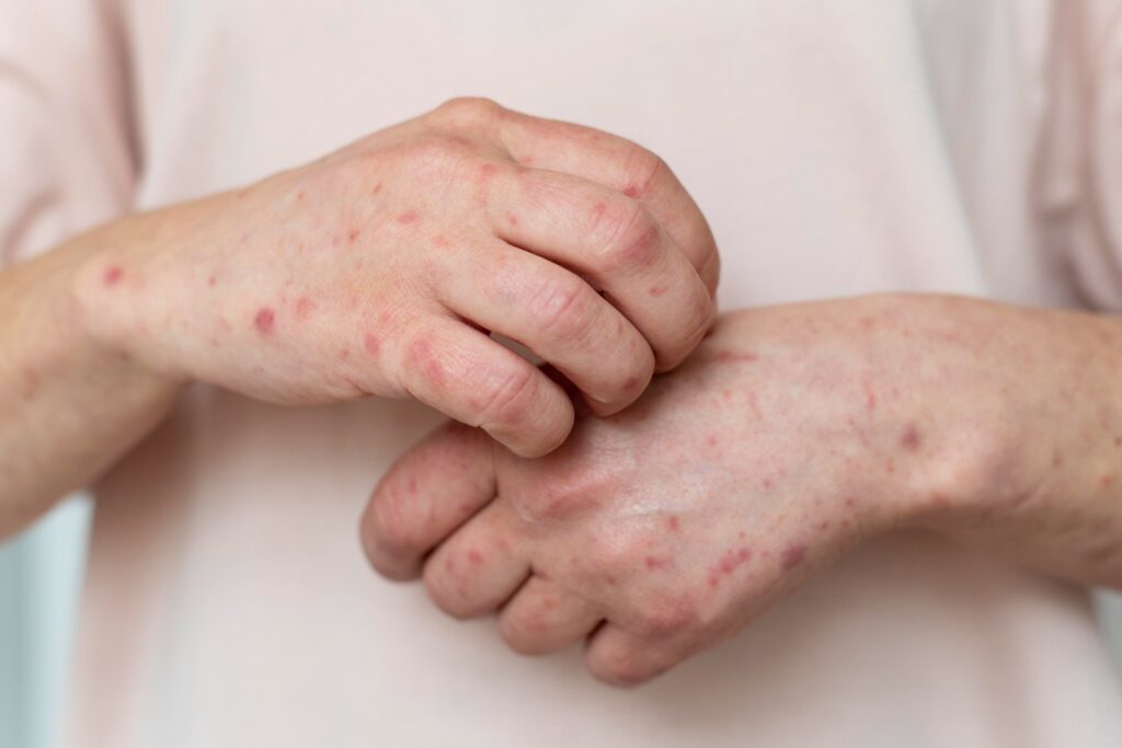 México acumula 24 muertes y casi seis mil casos de sarampión