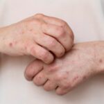 México acumula 24 muertes y casi seis mil casos de sarampión