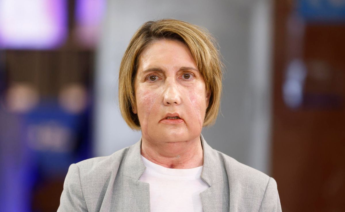 Realizan el primer trasplante facial del mundo con donante que recibió la eutanasia Realizan el primer trasplante facial del mundo con donante que recibió la eutanasia