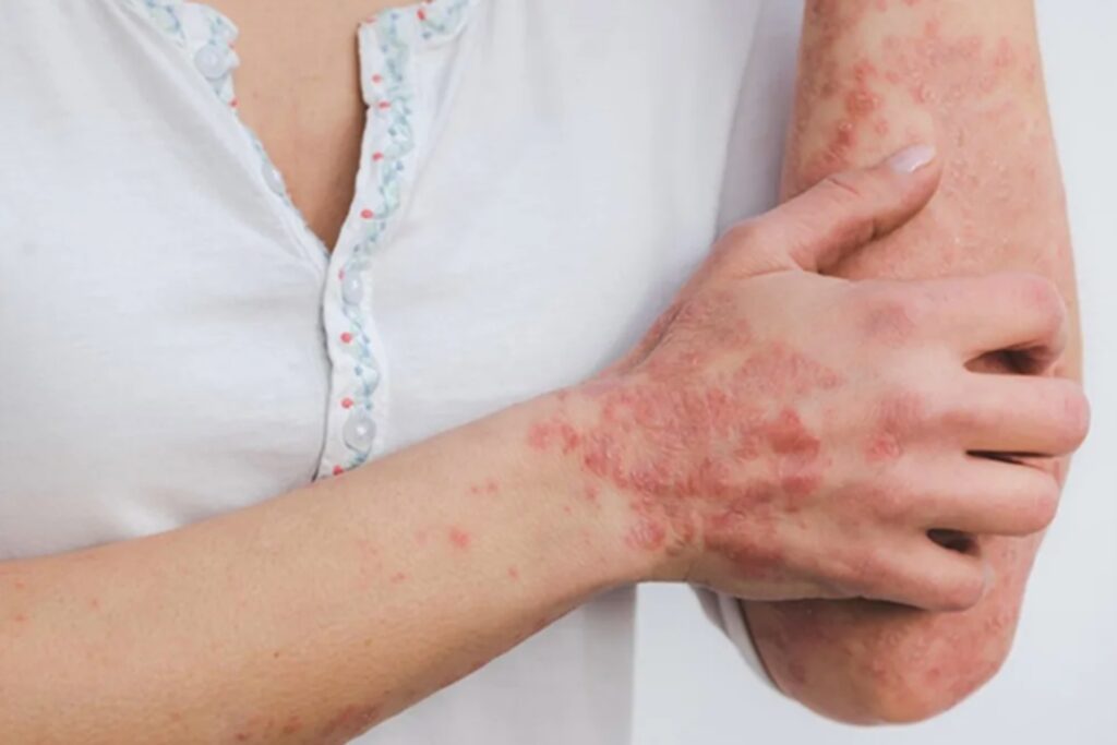 Descubren que un fármaco para la leucemia reduce los síntomas de la psoriasis