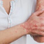 Descubren que un fármaco para la leucemia reduce los síntomas de la psoriasis