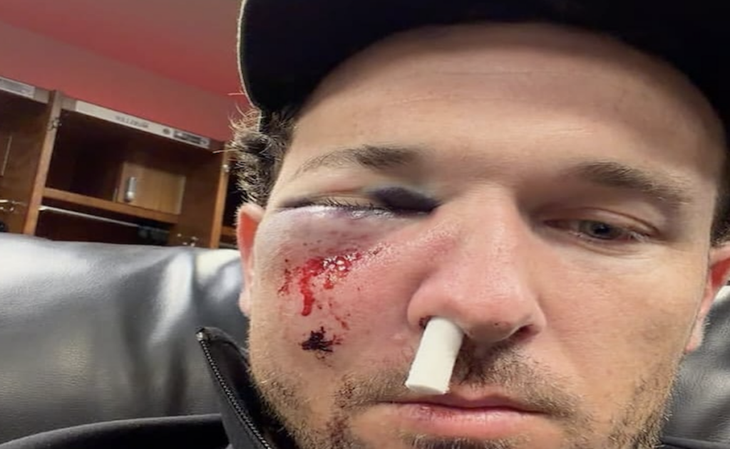 Accidente en Grandes Ligas: pelotazo manda al hospital a Alex Bregman