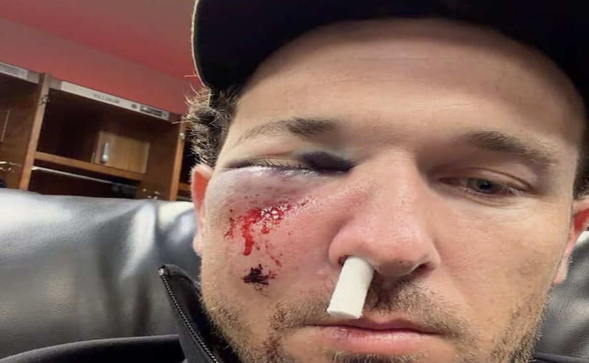 Accidente en Grandes Ligas: pelotazo manda al hospital a Alex Bregman