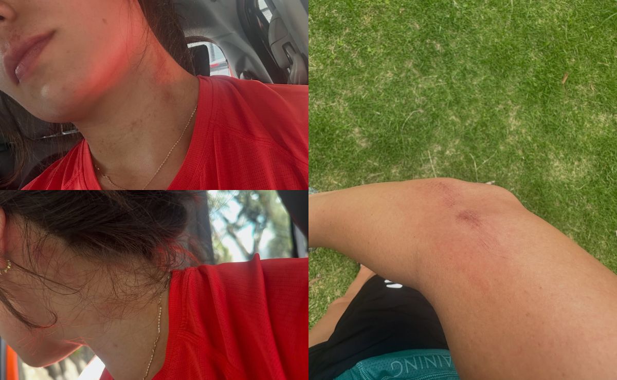 Cae acosador de mujeres en el Bosque del Ocotal, Cuajimalpa; sería agresor de la pentatleta Catherine Mayran - lesiones-de-catherine-mayran-tras-ser-agredida-en-el-bosque-del-ocotal